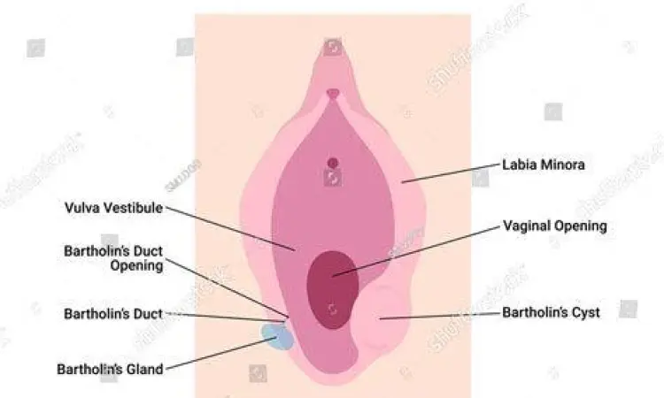 Ilustrasi letak kista bartholin pada anatomi wanita