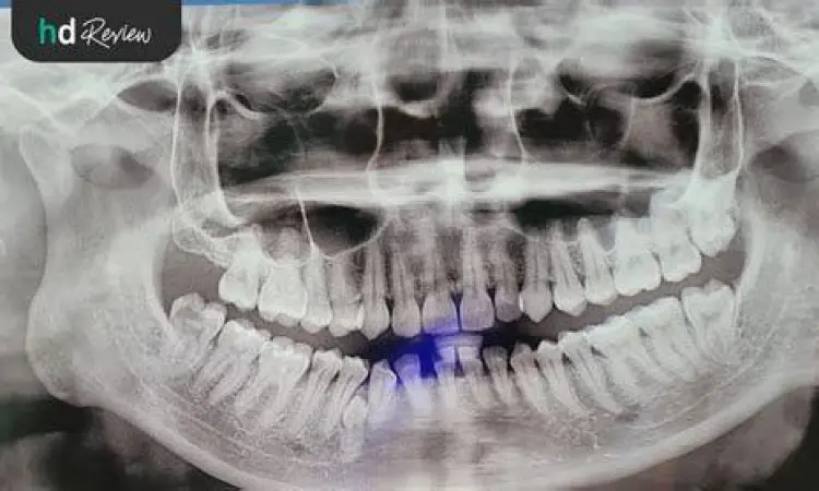 Hasil rontgen panoramik untuk perencanaan kawat gigi