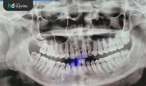 Rontgen Gigi Ortodonti Hasil rontgen panoramik untuk perencanaan kawat gigi