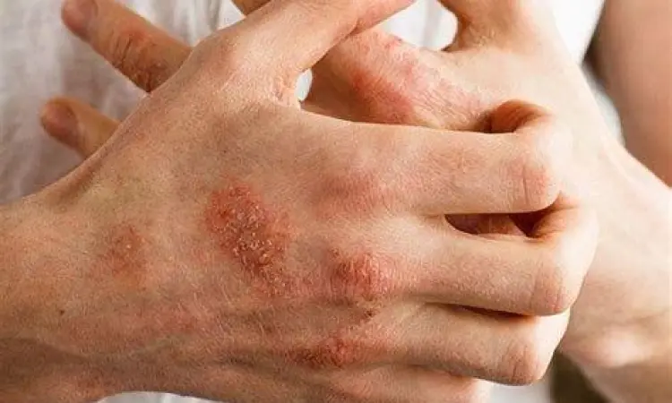 Gejala eksim dishidrotik pada telapak tangan