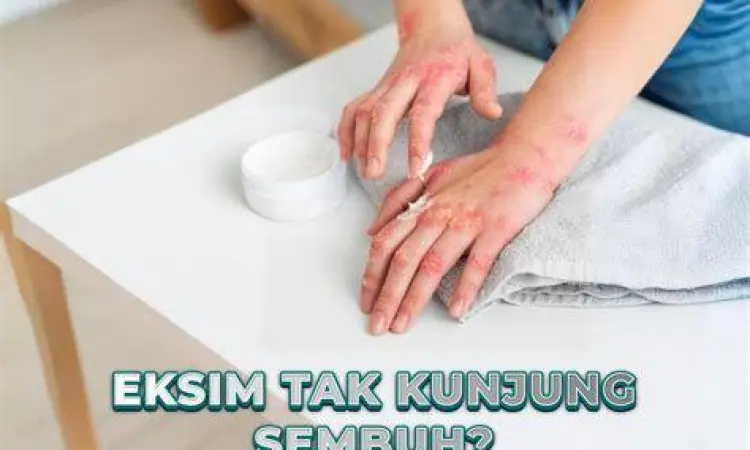 Berbagai faktor pemicu eksim dalam kehidupan sehari-hari