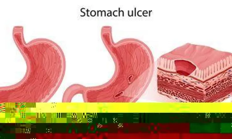 Ilustrasi tukak lambung penyebab perdarahan