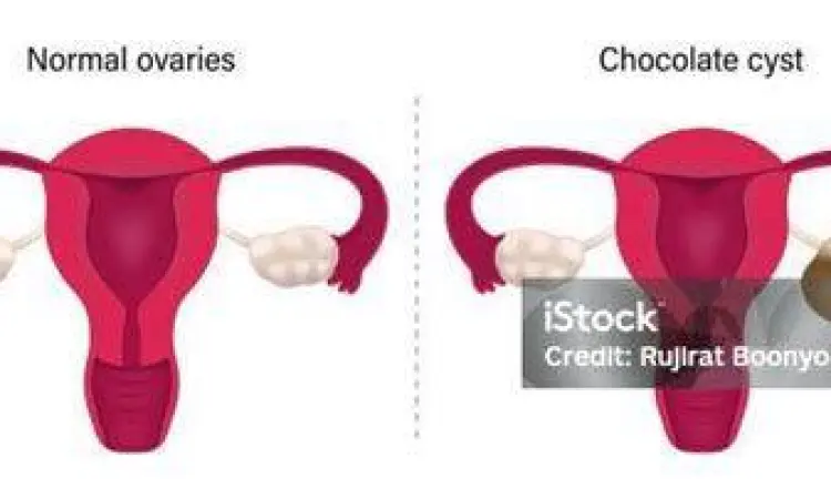 Anatomi Kista Ovarium Struktur anatomi kista ovarium pada organ reproduksi