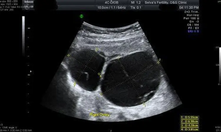 Deteksi Kista dengan USG Prosedur USG transvaginal untuk deteksi kista ovarium