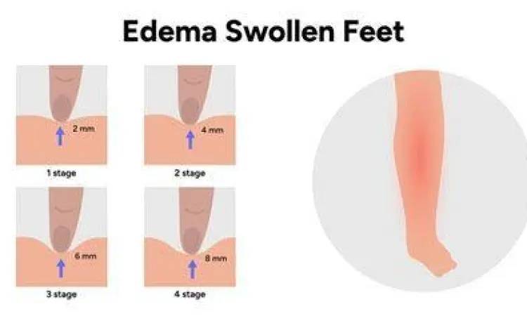 Visualisasi Edema Perbandingan kaki normal dan kaki yang mengalami edema