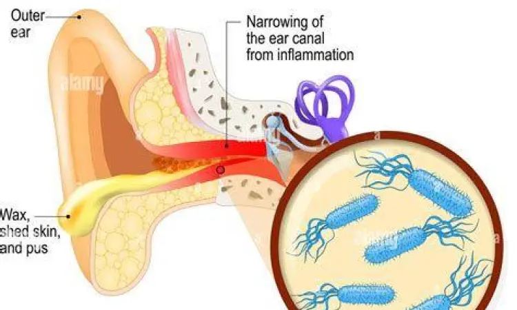 Peradangan pada saluran telinga luar atau otitis eksterna