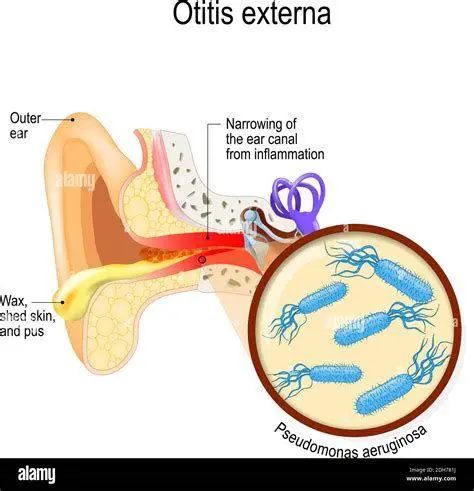 Otitis Externa Kondisi Telinga Peradangan pada saluran telinga luar atau otitis eksterna