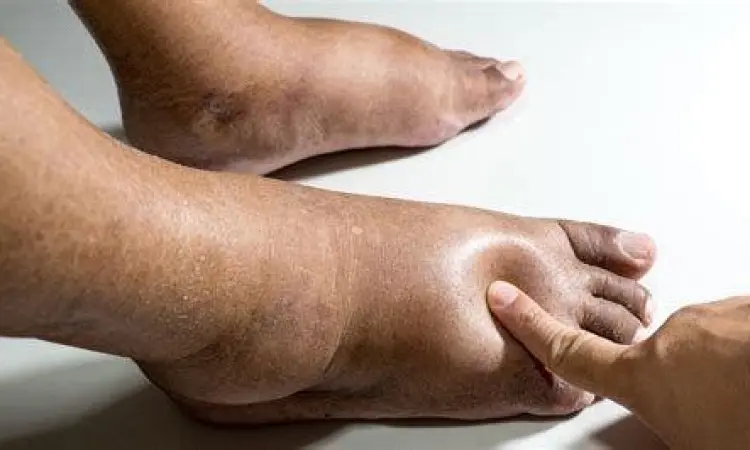 Gejala Edema Kaki Pembengkakan pada kaki akibat retensi cairan