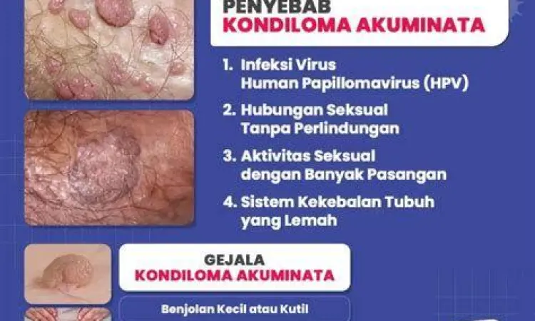 Gejala Kutil Kelamin Wanita Visualisasi gejala kutil kelamin pada wanita secara umum