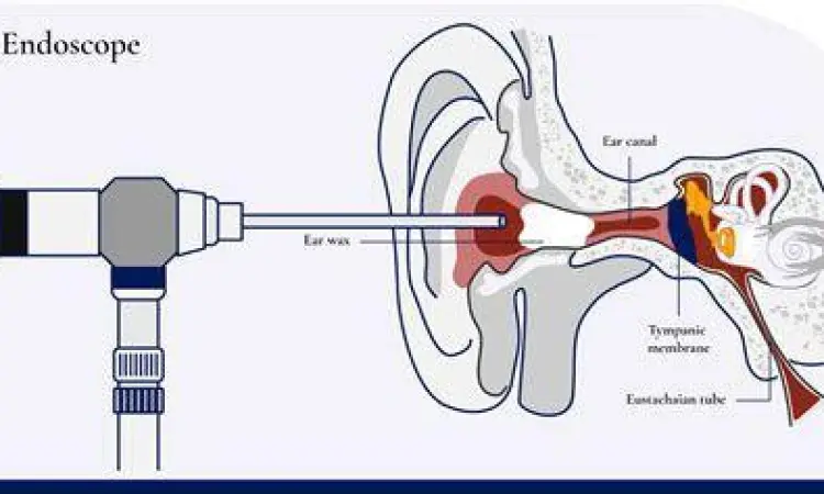 Diagram mekanisme kerja surfaktan pada serumen