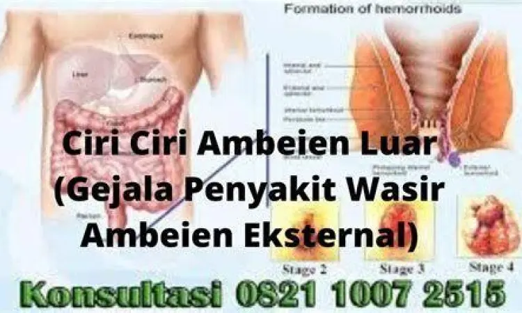 Ilustrasi gejala ambeien luar pada area anus
