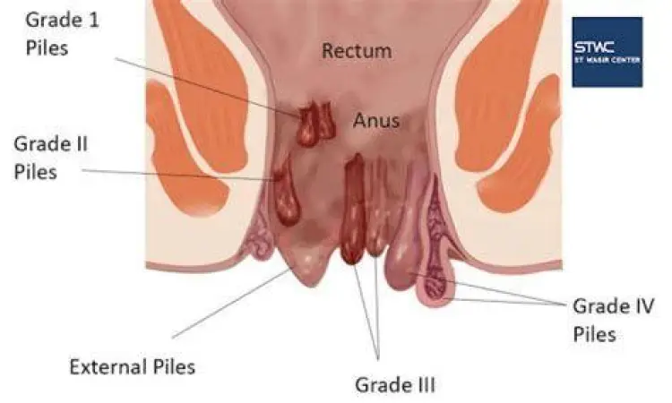 Komplikasi serius pada wasir stadium akhir