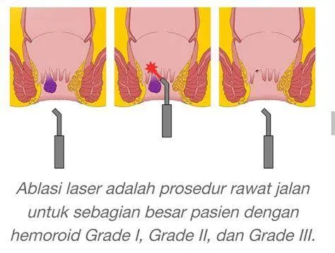 Operasi Ambeien Laser Prosedur laser untuk pengobatan ambeien stadium akhir