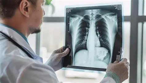 Rontgen Dada Pasien TBC Hasil rontgen dada pasien TB paru menunjukkan bercak putih