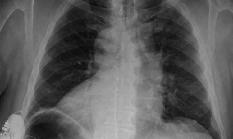 Hasil rontgen dada dextrocardia