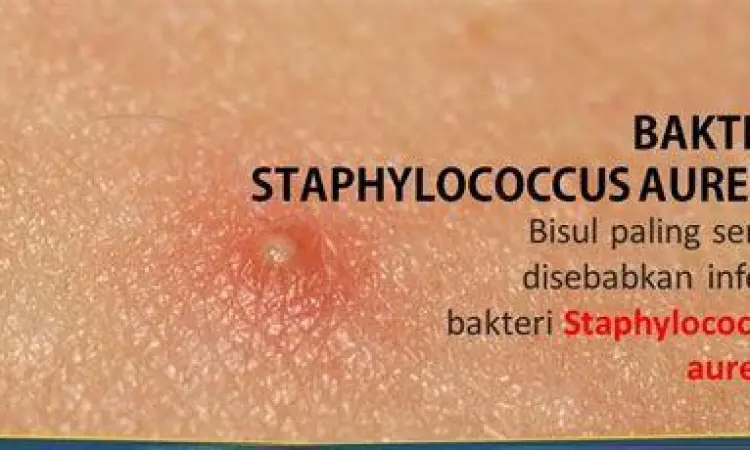 Bakteri Penyebab Bisul Bakteri Staphylococcus aureus penyebab bisul