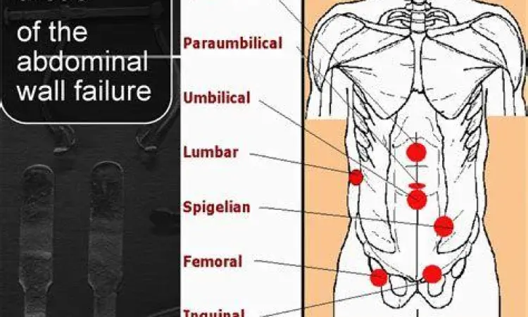 Anatomi dinding perut dan risiko hernia