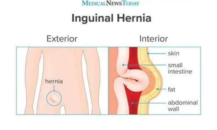 Diagram gejala hernia inguinal pada pria