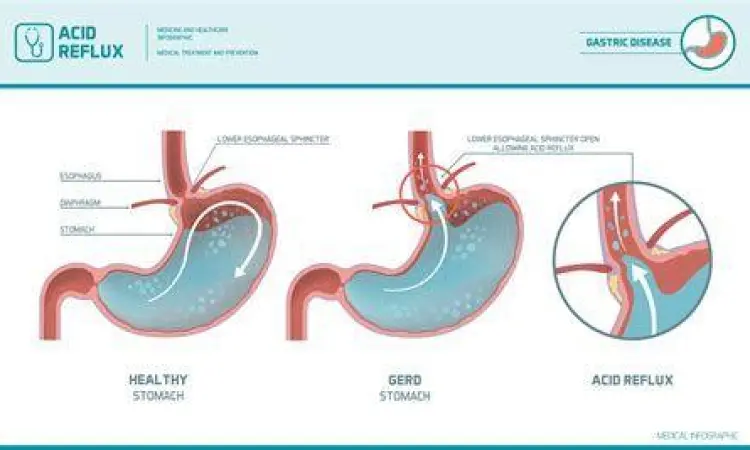 mekanisme asam lambung naik ke kerongkongan